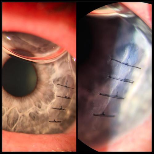 Penetrating trauma of the cornea - after suture